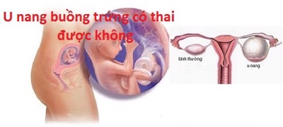 Chị em phụ nữ bị u nang buồng trứng có thai được không?