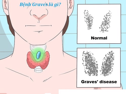 Bệnh graves là gì? Có nguy hiểm không và chữa như thế nào?