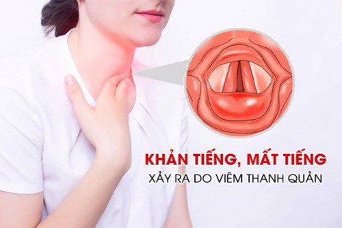 Phiền toái khi viêm thanh quản