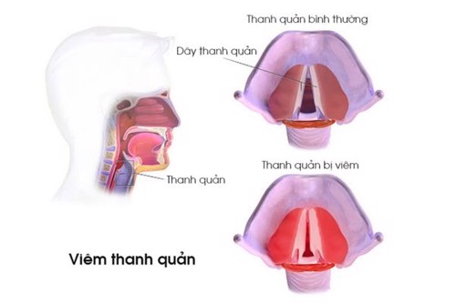 Tình trạng viêm thanh quản!!