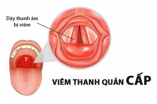 Chữa viêm amidan đơn giản mà hiệu quả!