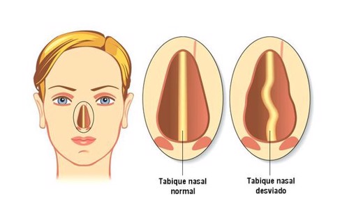 Nghiên cứu dịch tể vẹo vách ngăn mũi