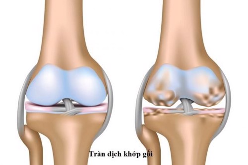  Tìm hiểu về phương pháp chọc hút dịch khớp trong điều trị tràn dịch khớp gối 