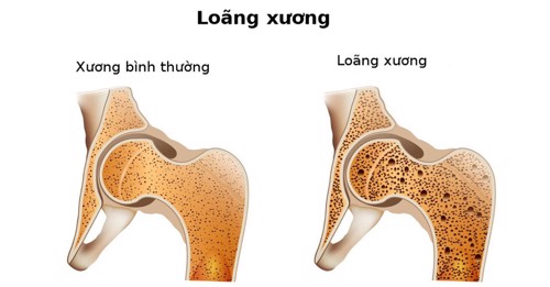 Bệnh nhân viêm khớp dạng thấp dễ bị loãng xương