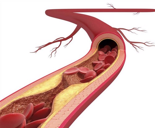 Rối loạn lipid máu và xơ vữa động mạch 