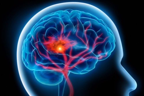 Cần cảnh giác các triệu chứng của tai biến mạch máu não