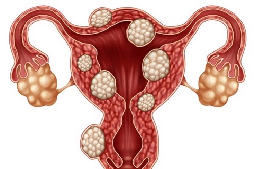 Điều trị u nang buồng trứng