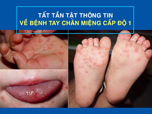 Tất tần tật thông tin về bệnh tay chân miệng cấp độ 1